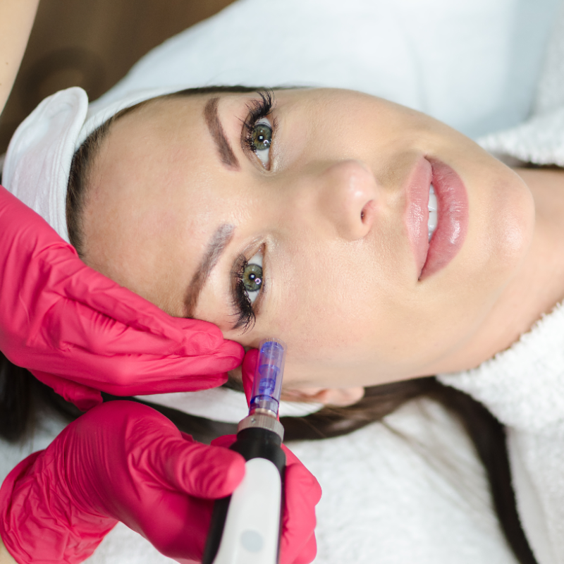 Professionelle Microneedling-Behandlung zur Hautverjüngung und Verbesserung der Hautstruktur